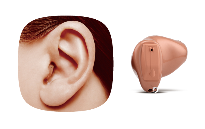 耳穴型